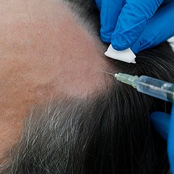 Unveiling the Dark Side of Hair Restoration: Black Market Clinics