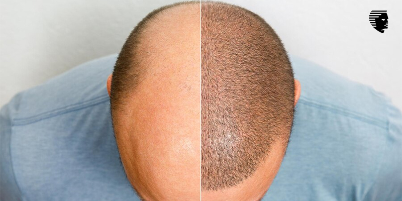 Why is India a Leader in Hair Transplants?