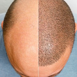 Post FUE: Will Hair Grow Back in the Donor Area