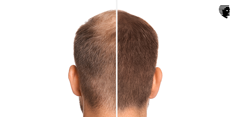 Post FUE: Will Hair Grow Back in the Donor Area