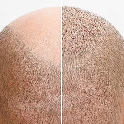 Decoding the Effectiveness of Hair Loss Treatments