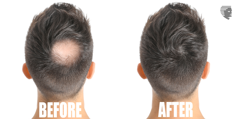 Permanent Hair Damage from Fake Hair Loss Treatments