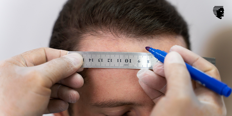 Why does Hairline Design Matters Most in Hair Transplant