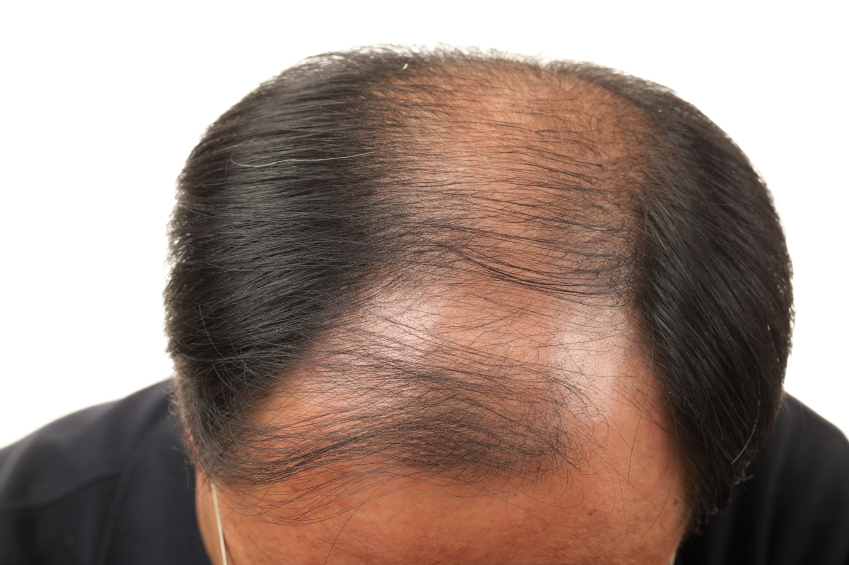 Reasons of hair loss – Prevention & its Cure – Advanced Hair Studio