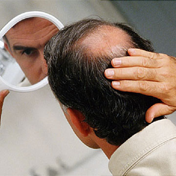 6 Proven Things To Recover Hair Loss