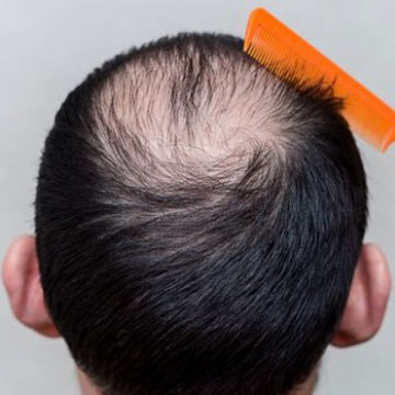 HAIR LOSS? GENETIC OR ENVIRONMENTAL?