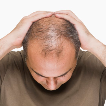 Tips for Hair Thinning Due to Male Pattern Baldness