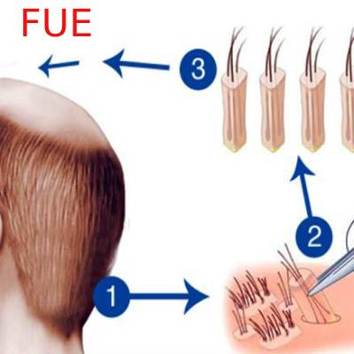 FUE - Can a Transplant Give You a Full Head of Hair Again?
