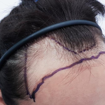 Hair Transplant: Permanent Solution For Hair Loss